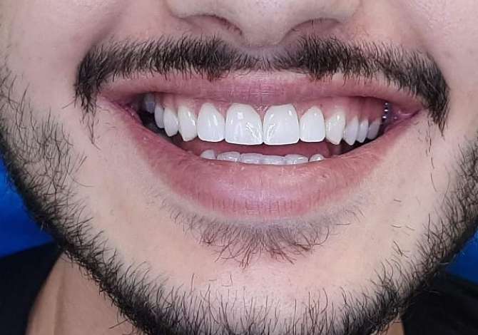 Servizi di salute e belleza  a Tirana - 1,000 Leke