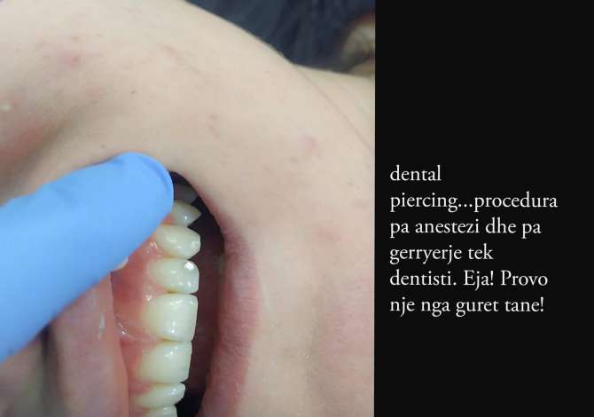 Klinika Dentare KetiDent ofron Mbushje estetike, Faseta dhe Buze, Zbardhim, Piercing, Fluorizim, Ura Porcelan dhe Zirkon etj.