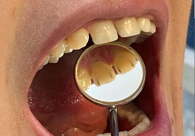 Klinike dentare Bitincka ofron sherbime per Kellef zirkoni, Pastrim/Heqje dhembesh, Lip filler