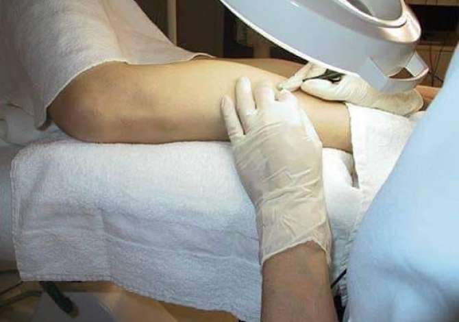 Klinike Dermatologjike Estetike Dermovita ofron Konsulence, Trajtim per Rrudhat, Celuliti, Djerses se tepert, Heqja e nishaneve, Dermapen