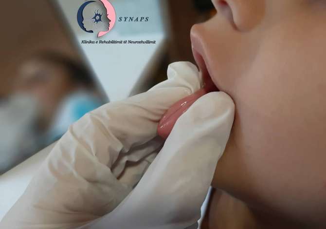 Klinike Rehabilitimi Fizio - Logopedik trajton crregullimet e neurozhvillimit ne Gjuhe dhe te Folur, Autizmi, Sindroma Down, Belbezimi, Prapambetje Mendore
