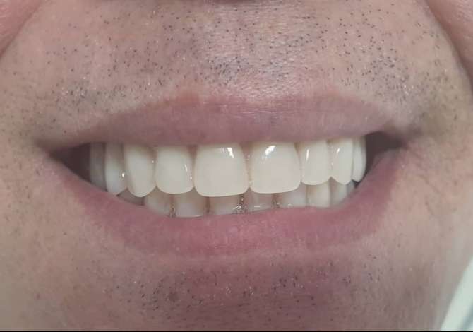 Klinike Dentare Prestige ofron Mbushje estetike Piercing, Estraksion dhemballe etj.