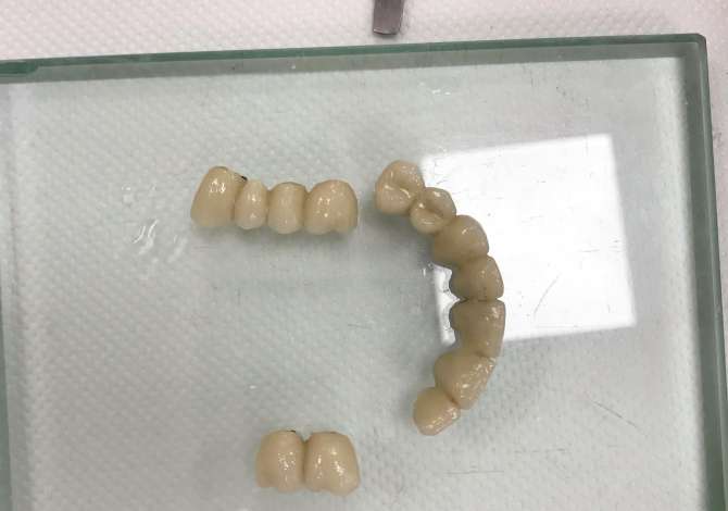 Klinika Dentare Cako ofron sherbime ne Endodontics, Diastema closure, Faseta kompoziti dhe Implante dentare