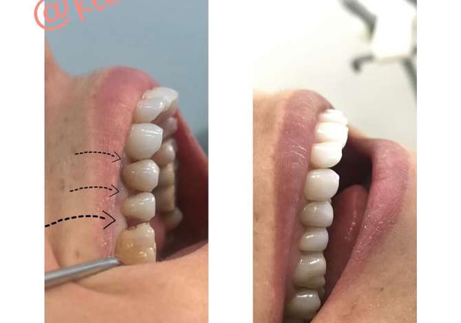 Klinika Dentare Cako ofron sherbime ne Endodontics, Diastema closure, Faseta kompoziti dhe Implante dentare