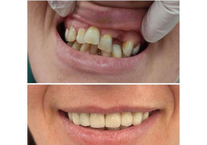 Klinika dentare Jon ofon sherbime si: Pastrim dhe Zbardhim, Mbushje te gradave te ndryshme, Extraksione (heqje), Implante etj