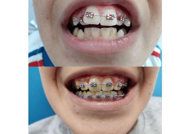 Klinika dentare Jon ofon sherbime si: Pastrim dhe Zbardhim, Mbushje te gradave te ndryshme, Extraksione (heqje), Implante etj