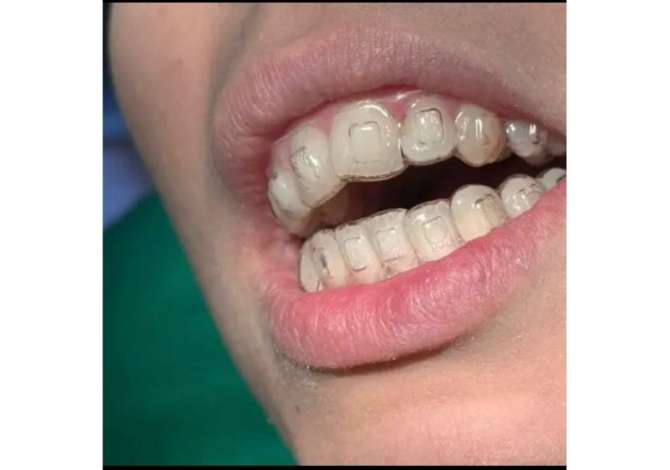 Klinika dentare Argjirodent ofron sherbime profesionale per implantologji, ortodonci fikse, drejtim dhembesh, zbardhim profesionale etj.